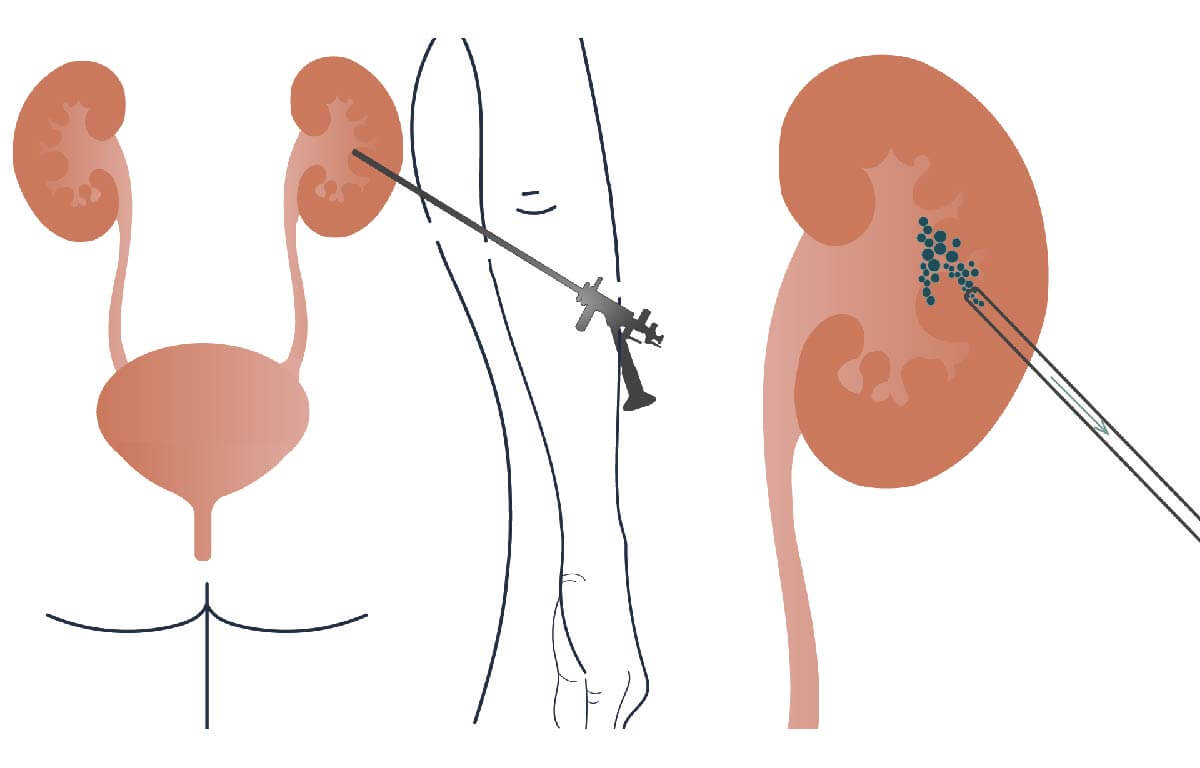 Nefrolitotripsia Percutânea