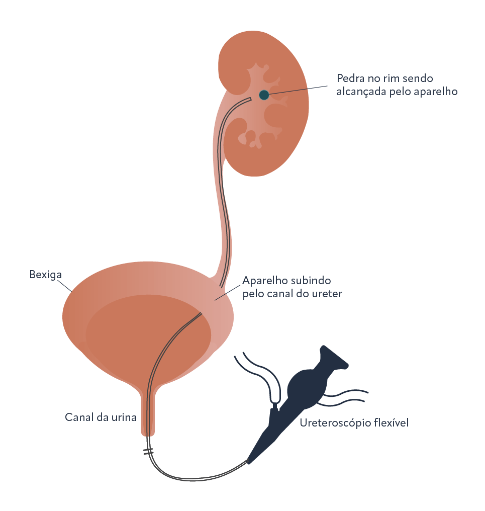 Ureterolitotripsia Flexível